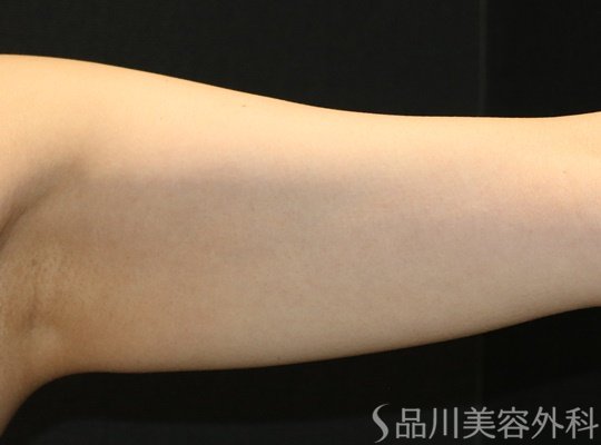 症例NO.74789のAFTER写真