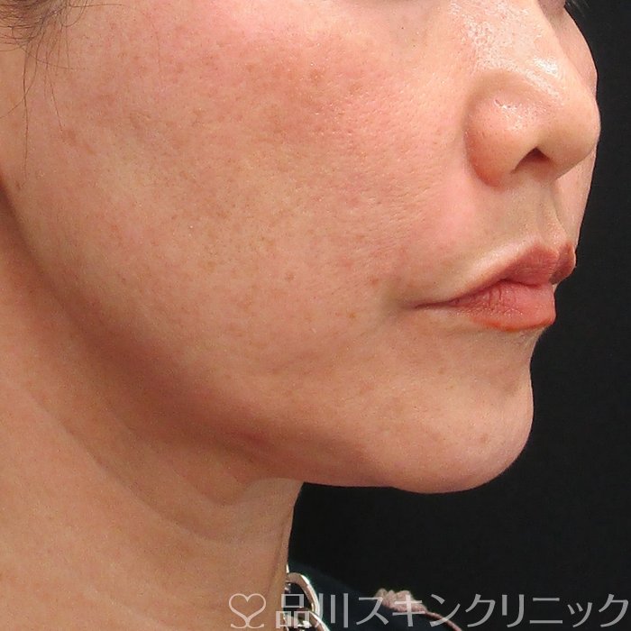 症例NO.75029のAFTER写真