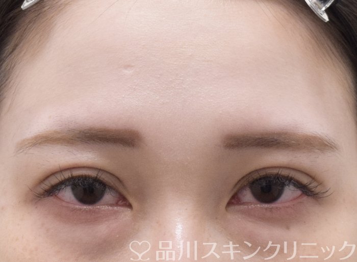 症例NO.73282のAFTER写真