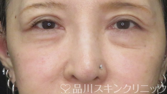 症例NO.72715のAFTER写真