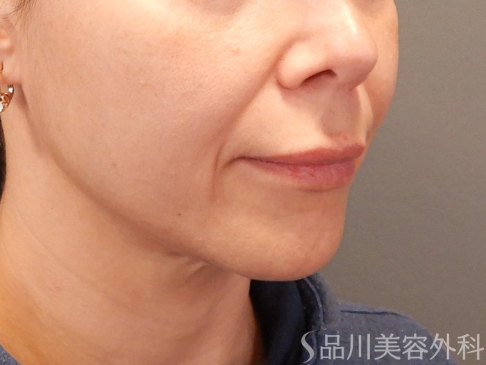 症例NO.69871のBEFORE写真