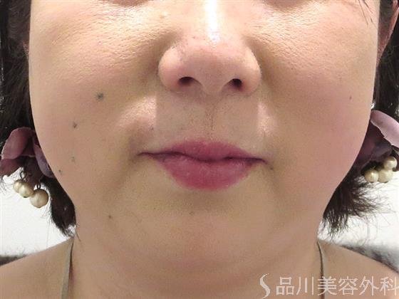 症例NO.21416のAFTER写真