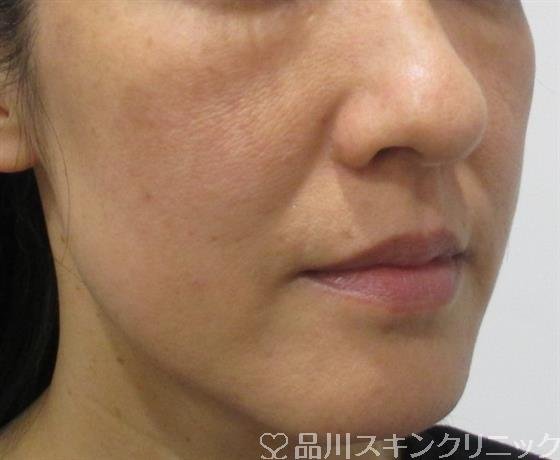 症例NO.32518のBEFORE写真