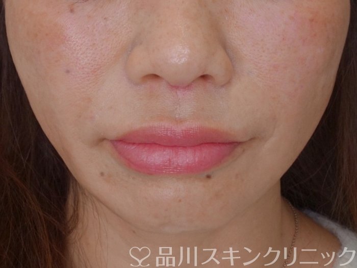 症例NO.73658のAFTER写真