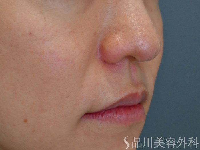 症例NO.72156のBEFORE写真