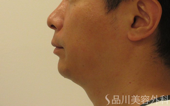 症例NO.71080のBEFORE写真
