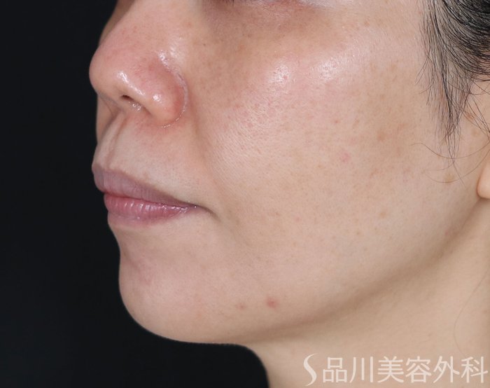 症例NO.71879のBEFORE写真