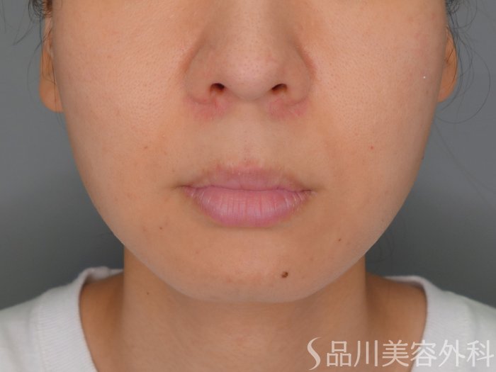 症例NO.70584のBEFORE写真