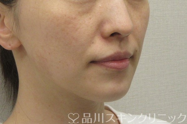 症例NO.74647のBEFORE写真