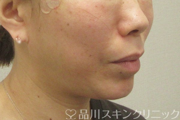 症例NO.75110のAFTER写真