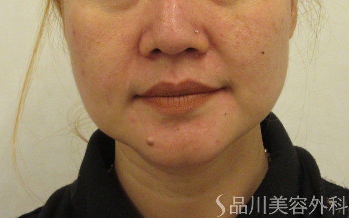 症例NO.72165のBEFORE写真