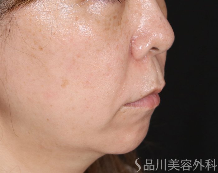 症例NO.72514のBEFORE写真