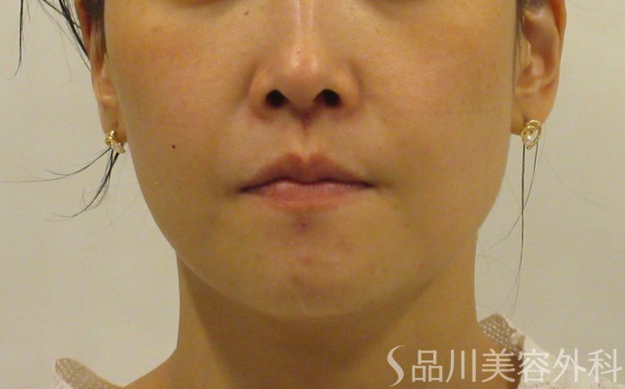 症例NO.71876のBEFORE写真