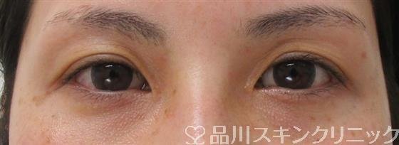 症例NO.43907のAFTER写真