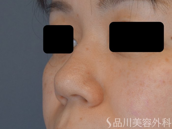 症例NO.72571のBEFORE写真