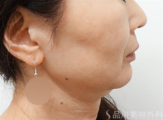 症例NO.26013のAFTER写真
