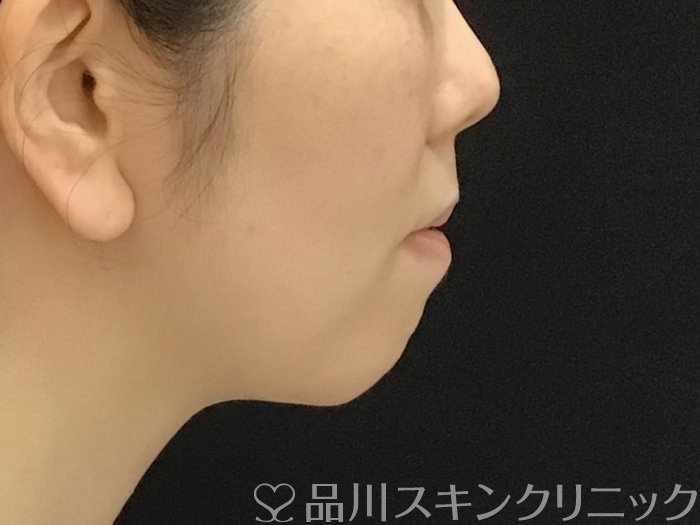 症例NO.70154のBEFORE写真
