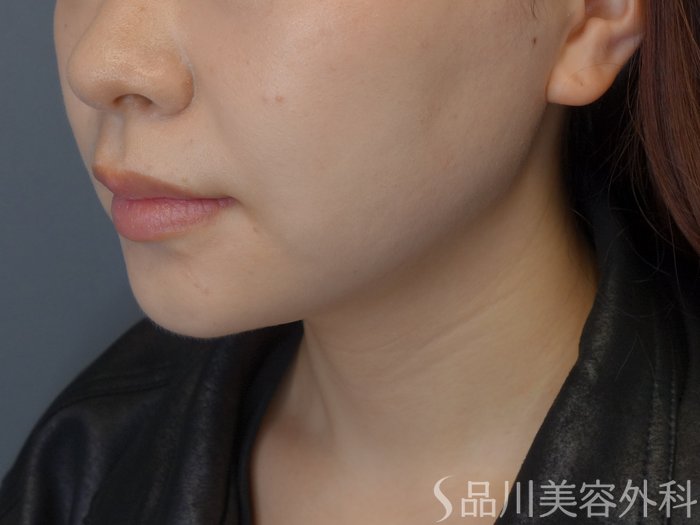 症例NO.72241のAFTER写真