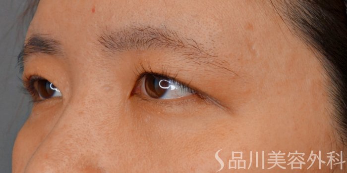 症例NO.73508のBEFORE写真