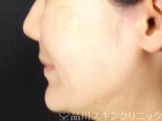症例NO.71655のBEFORE写真