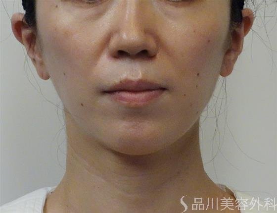 症例NO.52827のBEFORE写真