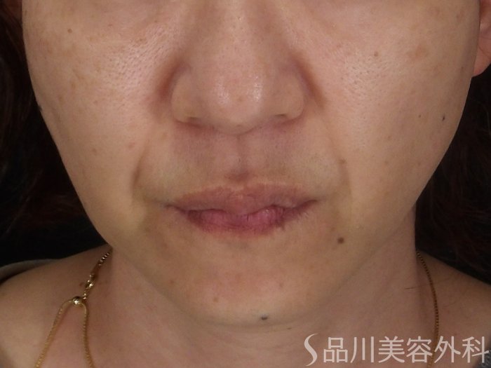 症例NO.70849のBEFORE写真