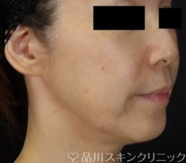 症例NO.71020のBEFORE写真