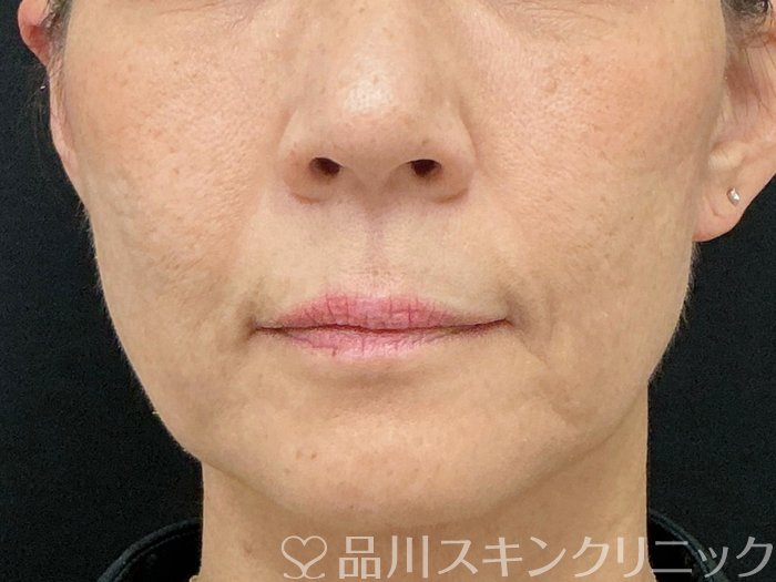 症例NO.74662のBEFORE写真