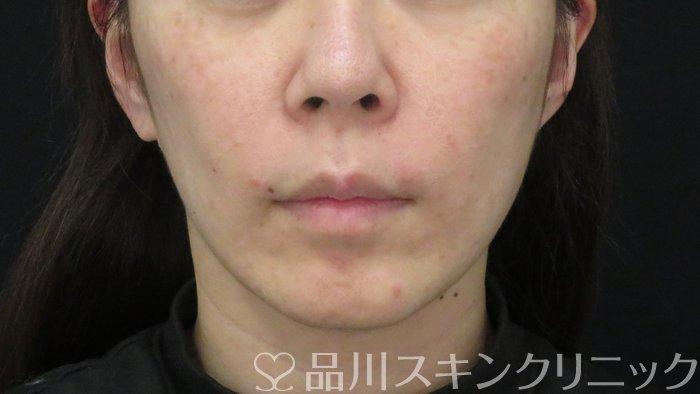 症例NO.72330のBEFORE写真