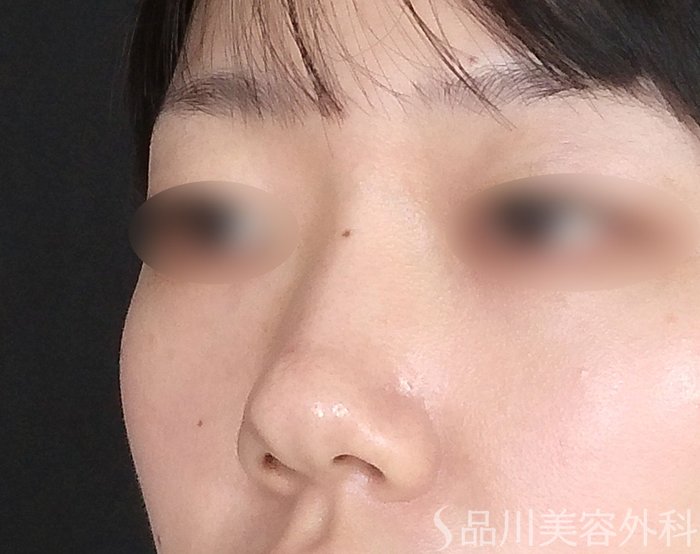 症例NO.65075のBEFORE写真