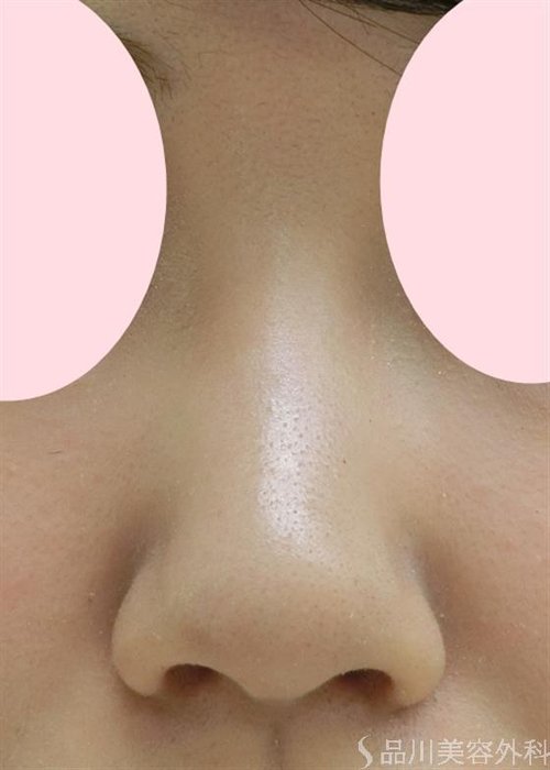 症例NO.28652のAFTER写真