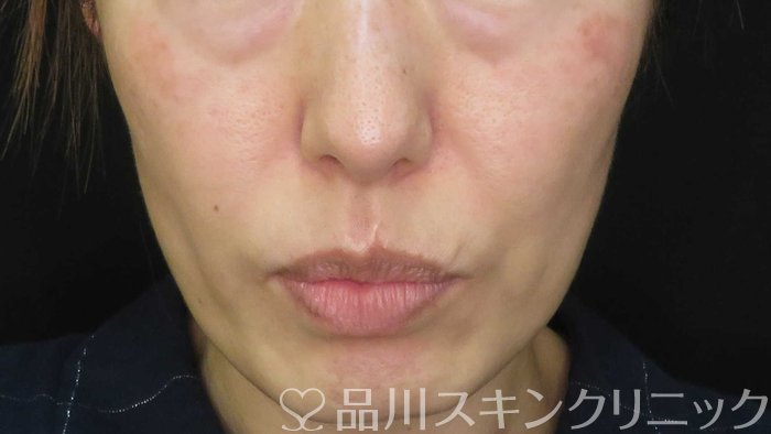 症例NO.71310のBEFORE写真