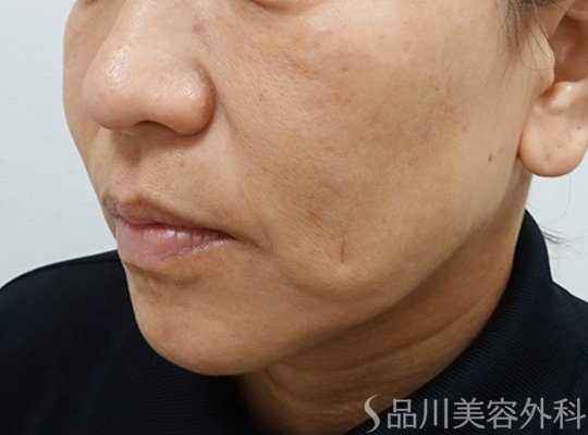 症例NO.72847のBEFORE写真