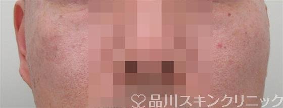 症例NO.33662のAFTER写真