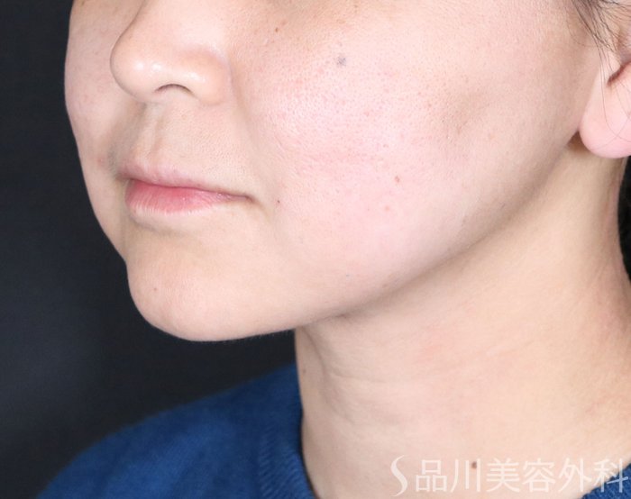 症例NO.73985のAFTER写真