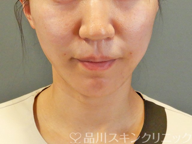 症例NO.63831のAFTER写真