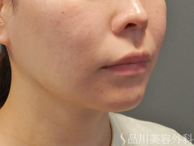 症例NO.73780のBEFORE写真