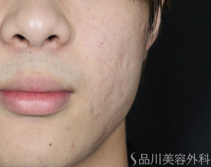 症例NO.71747のBEFORE写真