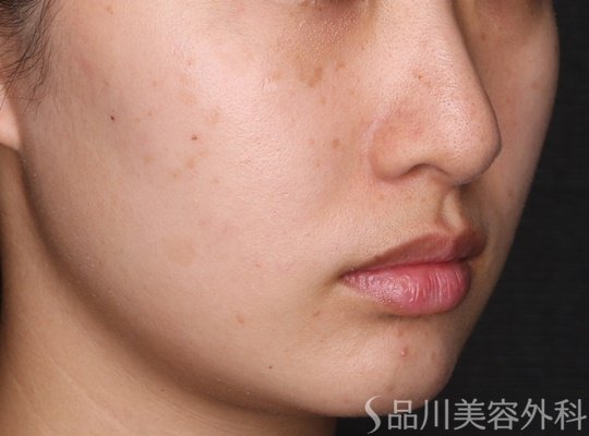 症例NO.75259のAFTER写真