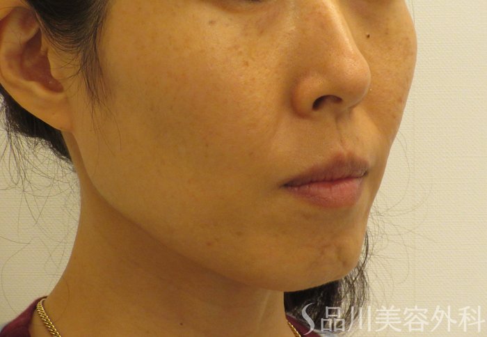 症例NO.71371のBEFORE写真