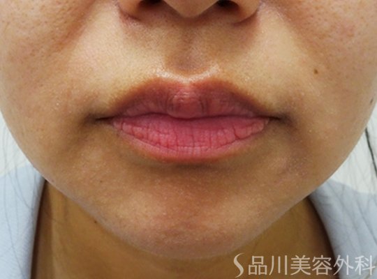 症例NO.72326のBEFORE写真