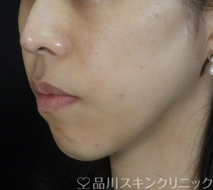 症例NO.67367のAFTER写真