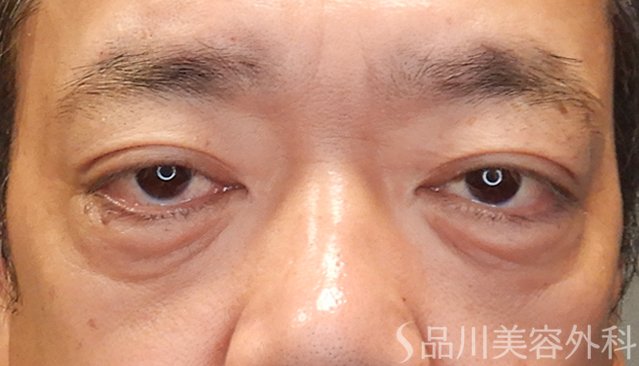 症例NO.75042のAFTER写真