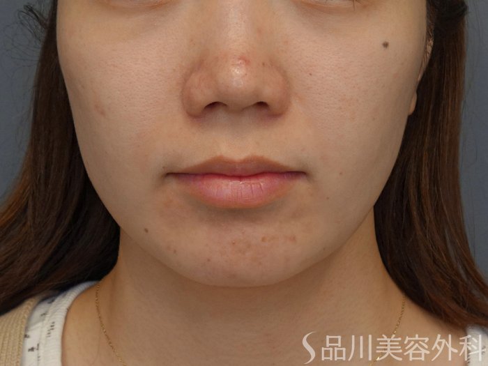 症例NO.74170のBEFORE写真