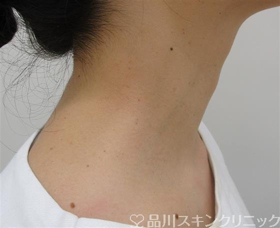 症例NO.41447のAFTER写真