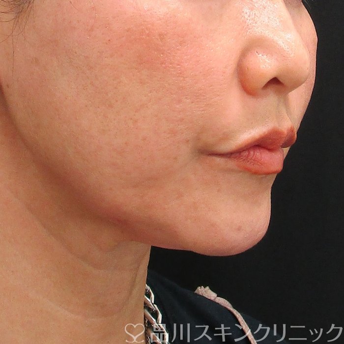 症例NO.75029のBEFORE写真