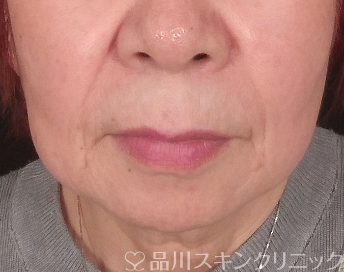 症例NO.69742のBEFORE写真