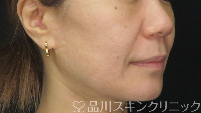 症例NO.71121のAFTER写真