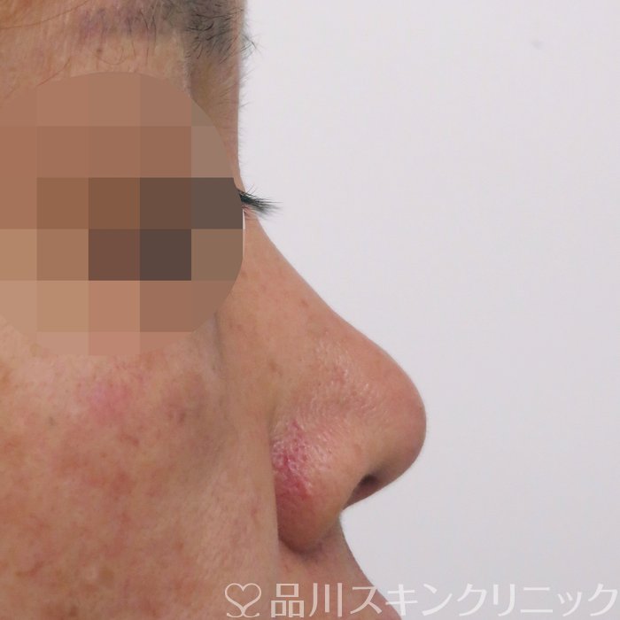 症例NO.70801のBEFORE写真