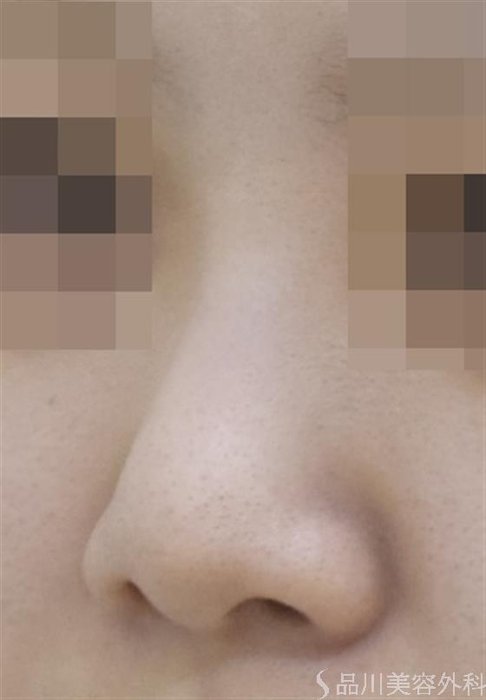 症例NO.54368のBEFORE写真